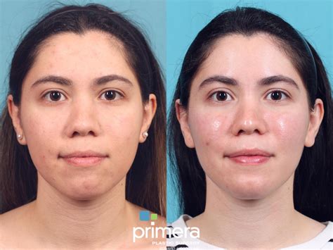 buccal fat removal norge|Bukkalfett Fjerning .